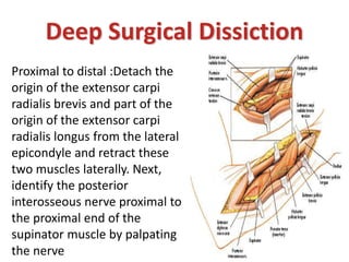 Deep Surgical Dissiction
Proximal to distal :Detach the
origin of the extensor carpi
radialis brevis and part of the
origin of the extensor carpi
radialis longus from the lateral
epicondyle and retract these
two muscles laterally. Next,
identify the posterior
interosseous nerve proximal to
the proximal end of the
supinator muscle by palpating
the nerve
 