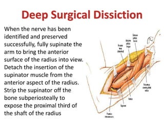 When the nerve has been
identified and preserved
successfully, fully supinate the
arm to bring the anterior
surface of the radius into view.
Detach the insertion of the
supinator muscle from the
anterior aspect of the radius.
Strip the supinator off the
bone subperiosteally to
expose the proximal third of
the shaft of the radius
Deep Surgical Dissiction
 