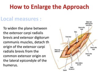 How to Enlarge the Approach
Local measures :
To widen the plane between
the extensor carpi radialis
brevis and extensor digitorum
communis muscles, detach the
origin of the extensor carpi
radialis brevis from the
common extensor origin on
the lateral epicondyle of the
humerus.
 