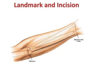 Landmark and Incision
 