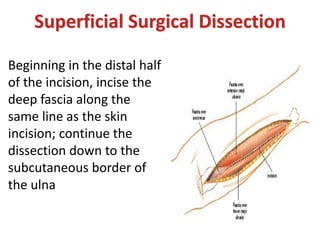 Superficial Surgical Dissection
Beginning in the distal half
of the incision, incise the
deep fascia along the
same line as the skin
incision; continue the
dissection down to the
subcutaneous border of
the ulna
 