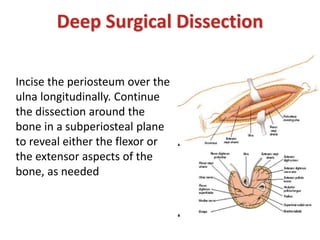 Deep Surgical Dissection
Incise the periosteum over the
ulna longitudinally. Continue
the dissection around the
bone in a subperiosteal plane
to reveal either the flexor or
the extensor aspects of the
bone, as needed
 
