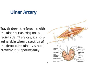 Ulnar Artery
Travels down the forearm with
the ulnar nerve, lying on its
radial side. Therefore, it also is
vulnerable when dissection of
the flexor carpi ulnaris is not
carried out subperiosteally
 