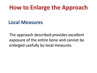 How to Enlarge the Approach
Local Measures
The approach described provides excellent
exposure of the entire bone and cannot be
enlarged usefully by local measures.
 