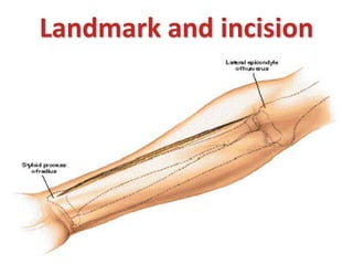 Landmark and incision
 