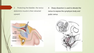 Sharp Ramus Approaches to Acetabulum- Dr Sharan | PPTX