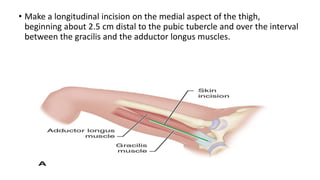 Longitudinal Incision Leg Approaches to hip joint | PPTX