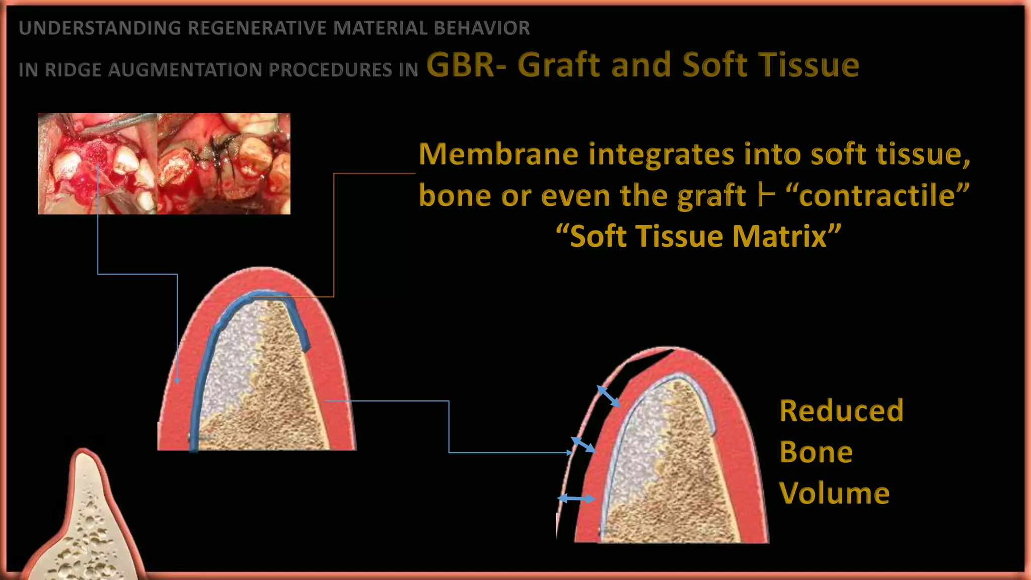 Approaches to ridge augmentation | PPTX