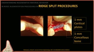 Approaches to ridge augmentation | PPTX
