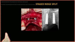 Split Ridge Augmentation Approaches to ridge augmentation | PPTX