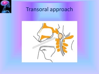 Transbasal Approach APPROACHES TO SKULL BASE AND APPLIED ASPECT.pptx