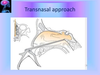 Transbasal Approach APPROACHES TO SKULL BASE AND APPLIED ASPECT.pptx