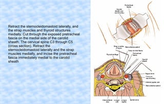 Retract the sternocleidomastoid laterally, and
the strap muscles and thyroid structures
medially. Cut through the exposed pretracheal
fascia on the medial side of the carotid
sheath. The cervical spine C3 through C5
(cross section). Retract the
sternocleidomastoid laterally and the strap
muscles medially, and incise the pretracheal
fascia immediately medial to the carotid
sheath

 