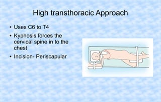 High transthoracic Approach
●
●

●

Uses C6 to T4
Kyphosis forces the
cervical spine in to the
chest
Incision- Periscapular

 
