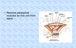 ●

Remove paraspinal
muscles as one unit from
spine

 