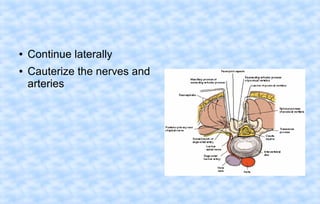 ●
●

Continue laterally
Cauterize the nerves and
arteries

 