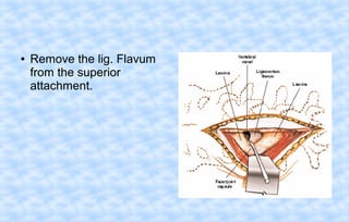 ●

Remove the lig. Flavum
from the superior
attachment.

 