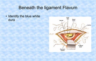 Beneath the ligament Flavum
●

Identify the blue white
dura

 