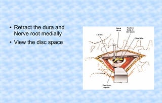 ●

●

Retract the dura and
Nerve root medially
View the disc space

 