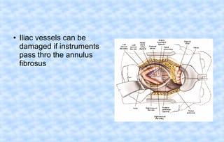●

Iliac vessels can be
damaged if instruments
pass thro the annulus
fibrosus

 