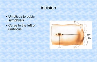 incision
●

●

Umblicus to pubic
symphysis
Curve to the left of
umblicus

 
