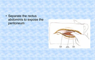 ●

Separate the rectus
abdominis to expose the
peritoneum

 