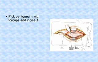 ●

Pick peritoneum with
forceps and incise it

 