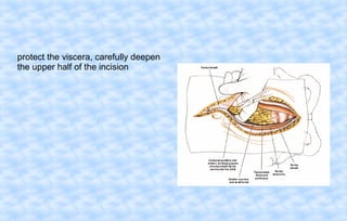 protect the viscera, carefully deepen
the upper half of the incision

 