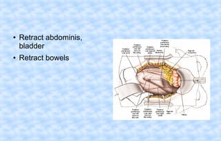 ●

●

Retract abdominis,
bladder
Retract bowels

 