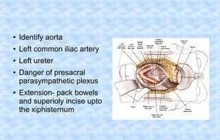 ●

Identify aorta

●

Left common iliac artery

●

Left ureter

●

●

Danger of presacral
parasympathetic plexus
Extension- pack bowels
and superioly incise upto
the xiphisternum

 