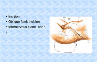 ●

Incision

●

Oblique flank incision

●

Internervous plane- none

●

 