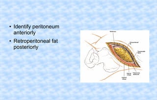 ●

●

Identify peritoneum
anteriorly
Retroperitoneal fat
posteriorly

 