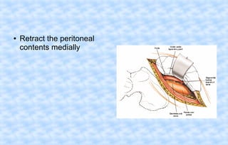 ●

Retract the peritoneal
contents medially

 
