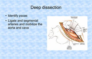 Deep dissection
●
●

Identify psoas
Ligate and segmental
arteries and mobilize the
aorta and cava

 