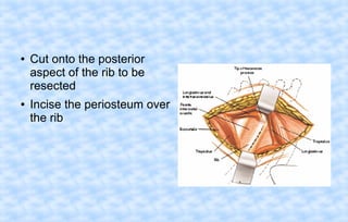 ●

●

Cut onto the posterior
aspect of the rib to be
resected
Incise the periosteum over
the rib

 