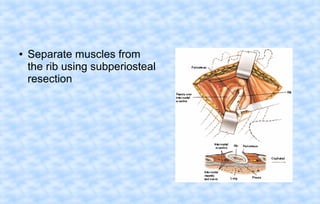●

Separate muscles from
the rib using subperiosteal
resection

 