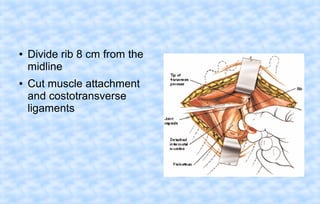 ●

●

Divide rib 8 cm from the
midline
Cut muscle attachment
and costotransverse
ligaments

 