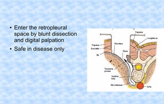 ●

●

Enter the retropleural
space by blunt dissection
and digital palpation
Safe in disease only

 
