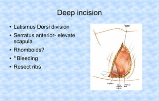 Deep incision
●
●

●

Latismus Dorsi division
Serratus anterior- elevate
scapula
Rhomboids?

●

Bleeding

●

Resect ribs

 