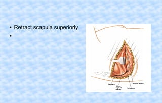 ●
●

Retract scapula superiorly

 