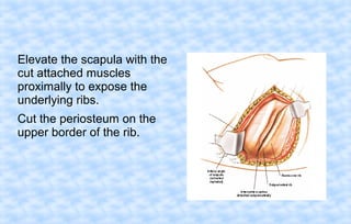 Elevate the scapula with the
cut attached muscles
proximally to expose the
underlying ribs.
Cut the periosteum on the
upper border of the rib.

 