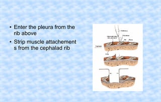 ●

●

Enter the pleura from the
rib above
Strip muscle attachement
s from the cephalad rib

 
