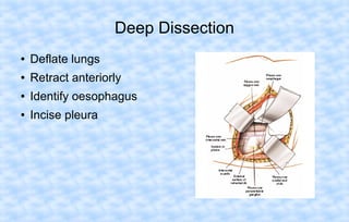 Deep Dissection
●

Deflate lungs

●

Retract anteriorly

●

Identify oesophagus

●

Incise pleura

 