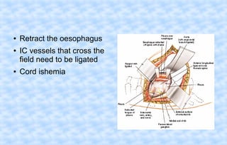 ●
●

●

Retract the oesophagus
IC vessels that cross the
field need to be ligated
Cord ishemia

 