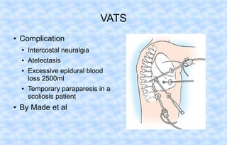 VATS
●

Complication
●

Intercostal neuralgia

●

Atelectasis

●

●

●

Excessive epidural blood
loss 2500ml
Temporary paraparesis in a
scoliosis patient

By Made et al

 