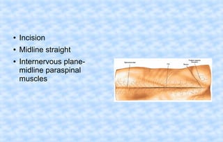 ●

Incision

●

Midline straight

●

Internervous planemidline paraspinal
muscles

 