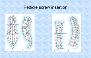 Pedicle screw insertion

 