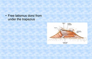 ●

Free latismus dorsi from
under the trapezius

 