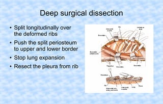 Deep surgical dissection
●

●

Split longitudinally over
the deformed ribs
Push the split periosteum
to upper and lower border

●

Stop lung expansion

●

Resect the pleura from rib

 