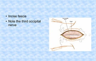 ●
●

Incise fascia
Note the third occipital
nerve

 
